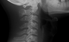 Cảnh báo cột sống cổ ‘thẳng như cây gậy’ ở người trẻ tuổi do sai tư thế kéo dài