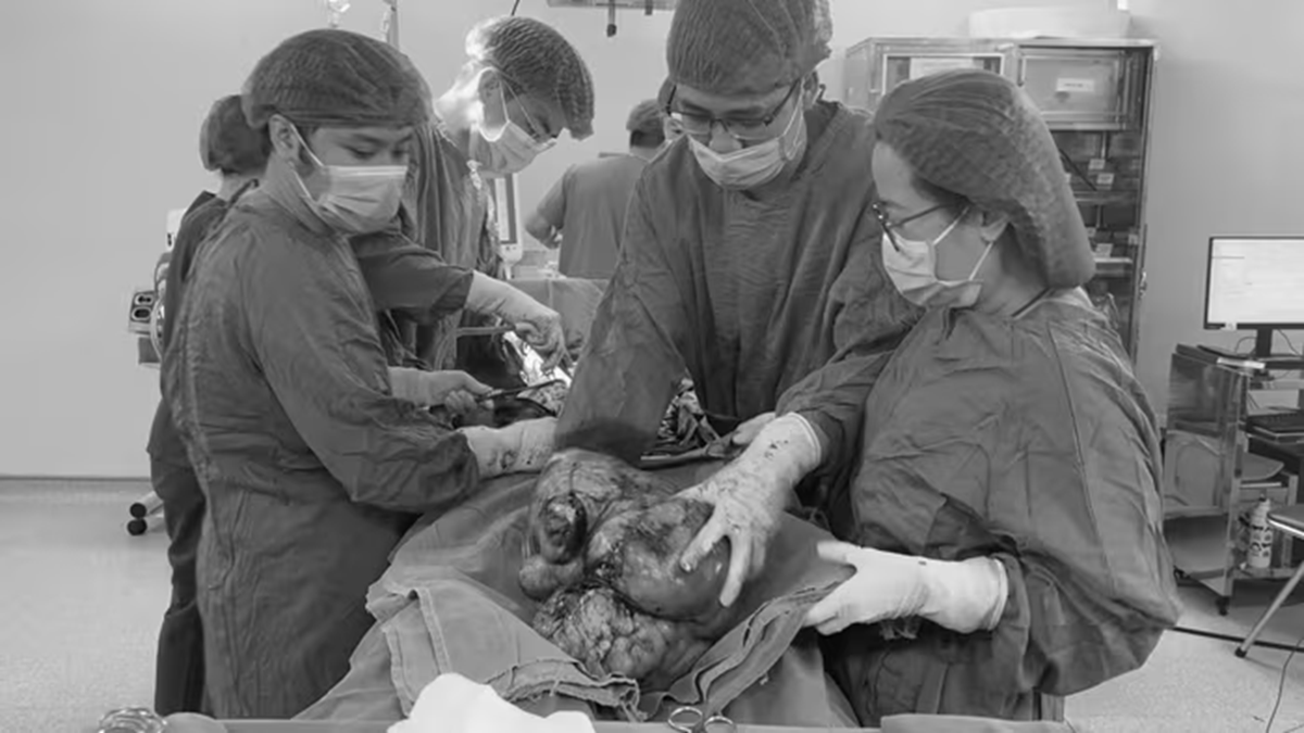 Đau âm ỉ vùng bụng suốt, người phụ nữ sốc khi bác sĩ lấy ra thứ "đáng sợ" trong cơ thể mình - Ảnh 1.