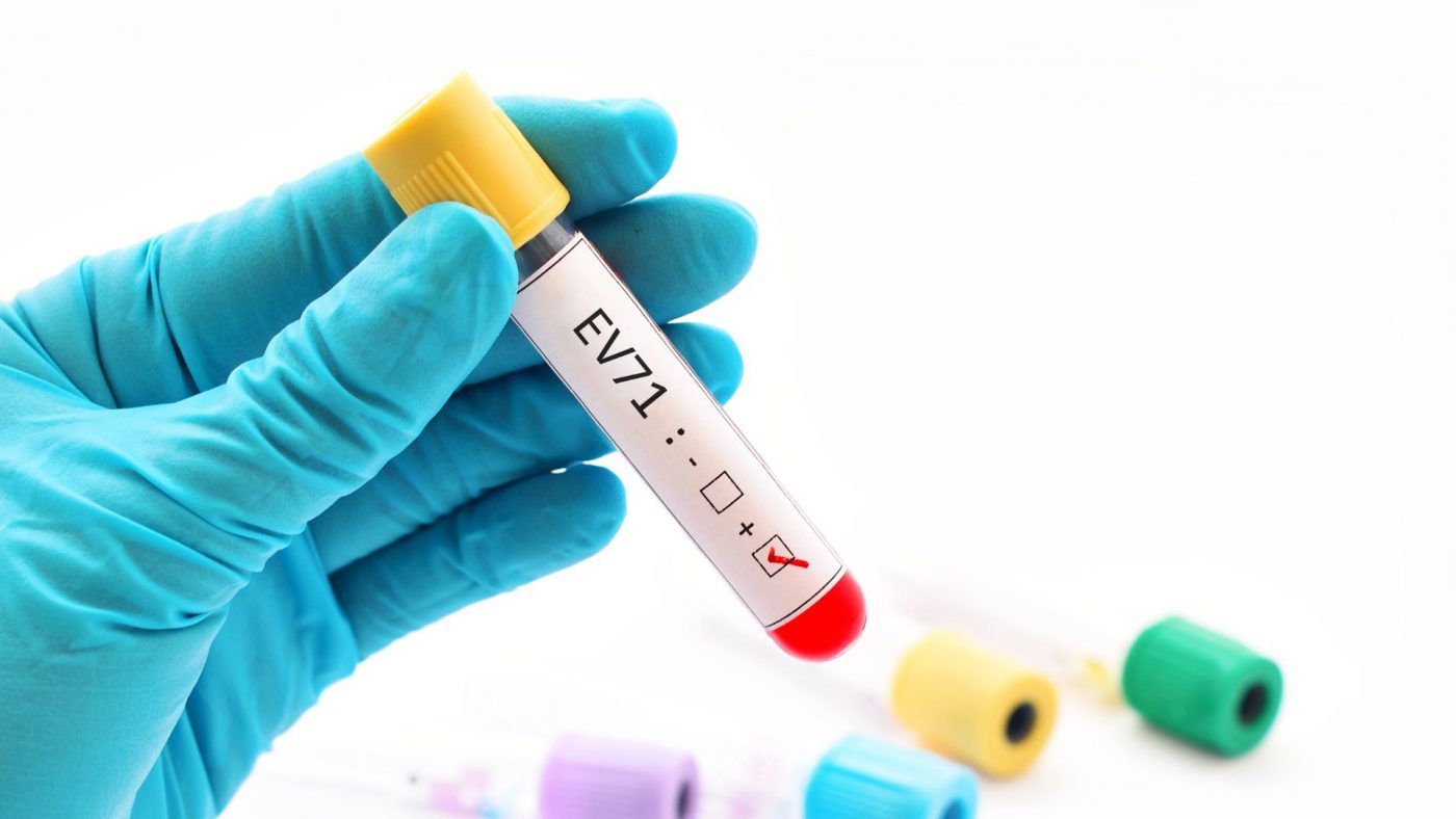 Thời gian lây bệnh tay chân miệng kéo dài bao lâu?- Ảnh 1. Thời gian lây bệnh tay chân miệng kéo dài bao lâu?- Ảnh 1.