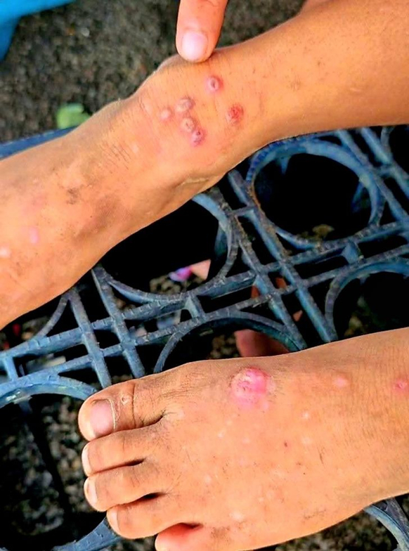 Thái Lan bật cảnh báo khi 23 người tử vong, 732 người bị lây nhiễm 1 căn bệnh, ở Việt Nam cũng đã xuất hiện- Ảnh 1.