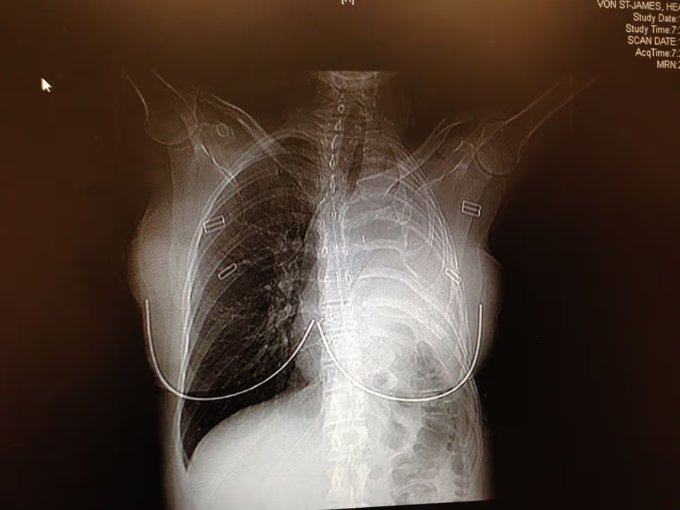 Người phụ nữ 36 tuổi chỉ còn sống được 15 tháng vì hồi nhỏ thích mặc áo của bố  - Ảnh 2.