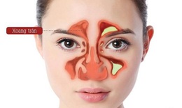 Bệnh viêm xoang trán: Triệu chứng, nguyên nhân và cách điều trị