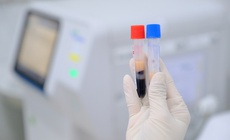 Cảnh giác với dấu hiệu dự báo nguy cơ đột quỵ bị bỏ sót ở người trẻ