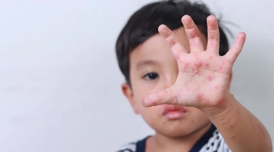 Vì sao bệnh tay chân miệng tăng mạnh ở trẻ mầm non vào đầu tuần?- Ảnh 1.