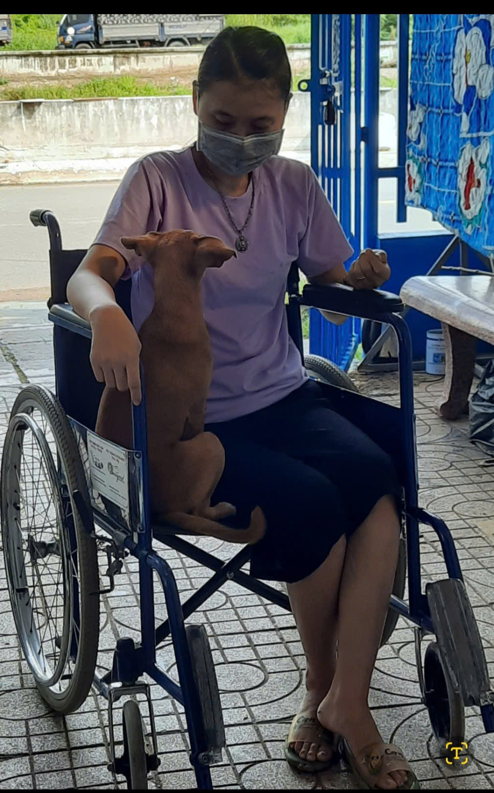 Dùng corticoid điều trị viêm da, người phụ nữ bị hoại tử khớp háng phải ngồi xe lăn - Ảnh 2.