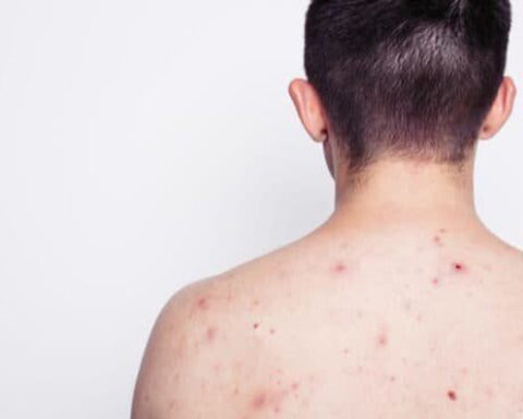 Nam thanh niên 23 tuổi nhiễm HIV sau khi tham gia lễ hội té nước tại Thái Lan