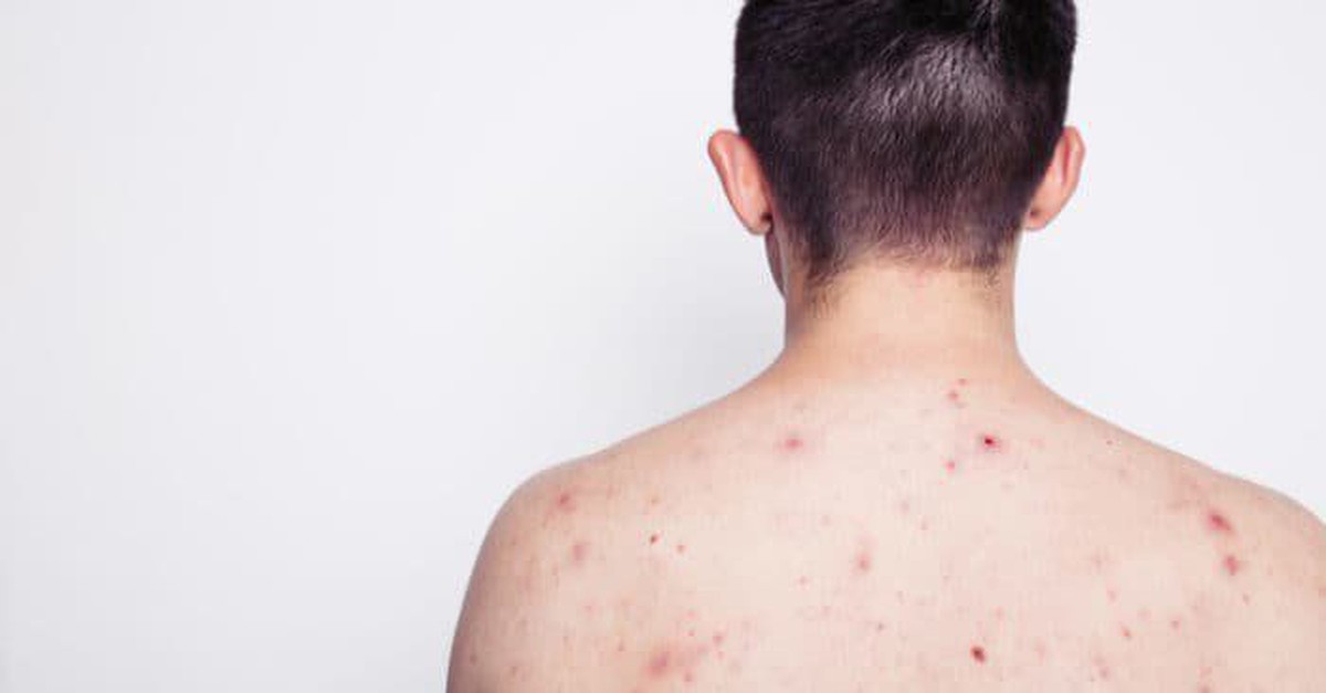 Nam thanh niên 23 tuổi nhiễm HIV sau khi tham gia lễ hội té nước tại Thái Lan