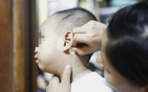 Bé 7 tuổi ở TP.HCM bị rối loạn tâm thần cấp tính: Bác sĩ phát hiện thủ phạm đến từ miếng dán chống say tàu xe