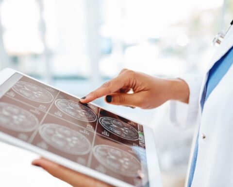 Đột quỵ do xuất huyết não đang gia tăng ở người trẻ: Đây là “thủ phạm” hàng đầu