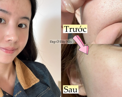 Làn da sần sùi, lỗ chân lông to của tôi đã thay đổi hoàn toàn nhờ dùng 2 loại sữa rửa mặt và chọn đúng serum