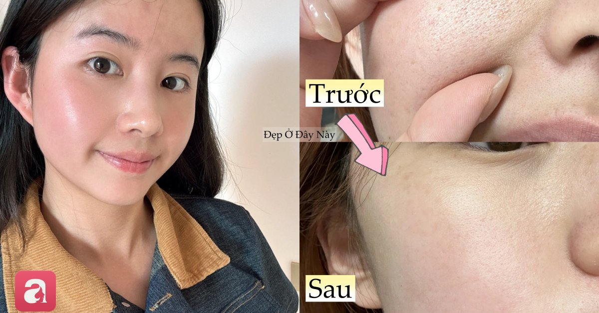 Làn da sần sùi, lỗ chân lông to của tôi đã thay đổi hoàn toàn nhờ dùng 2 loại sữa rửa mặt và chọn đúng serum