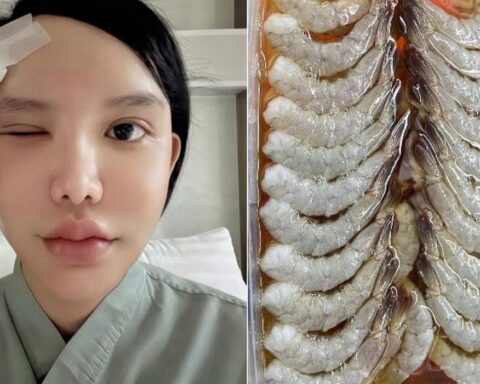 Người phụ nữ bị ký sinh trùng bò vào hốc mắt, suýt mù, bác sĩ cảnh báo 1 thói quen nhiều người Việt mắc phải