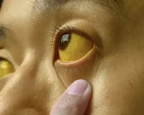 Nếu mắt có 6 thứ, đi khám ung thư ngay còn kịp!