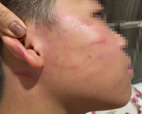 Vụ giáo viên nước ngoài tát học sinh: Gia đình nói bé trai bị thủng màng nhĩ