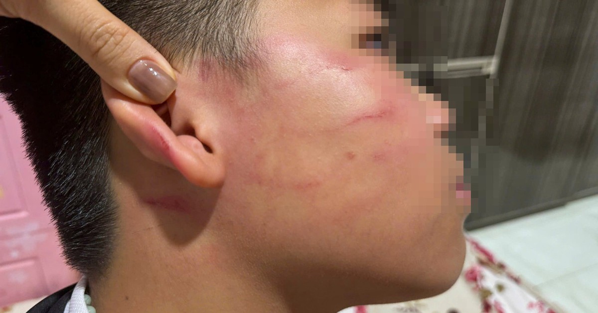 Vụ giáo viên nước ngoài tát học sinh: Gia đình nói bé trai bị thủng màng nhĩ