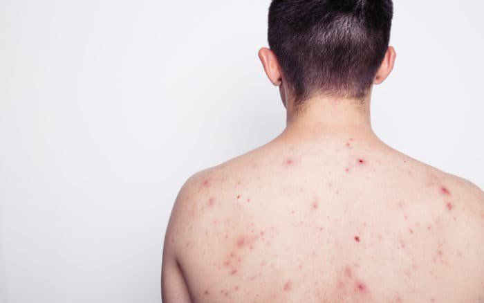 Nam thanh niên 25 tuổi nhiễm lậu: Sau khi tham gia lễ hội té nước tại Thái Lan - Ảnh 2.