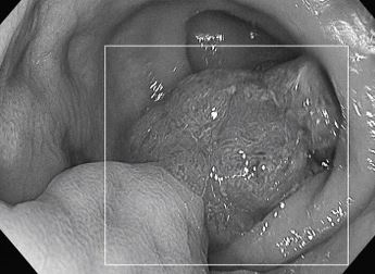 Bỏ qua dấu hiệu "lạ" suốt 1 năm, người đàn ông 50 tuổi sốc khi biết mắc ung thư - Ảnh 1.