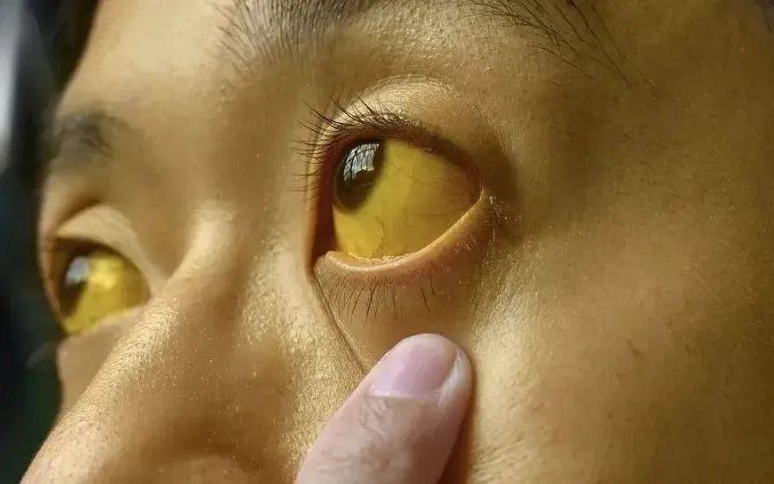 Bỏ qua dấu hiệu "lạ" suốt 1 năm, người đàn ông 50 tuổi sốc khi biết mắc ung thư - Ảnh 3.