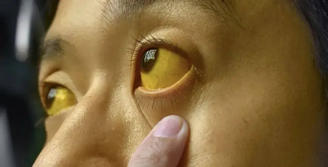 Nếu mắt có 6 thứ, đi khám ung thư ngay còn kịp! - Ảnh 2.