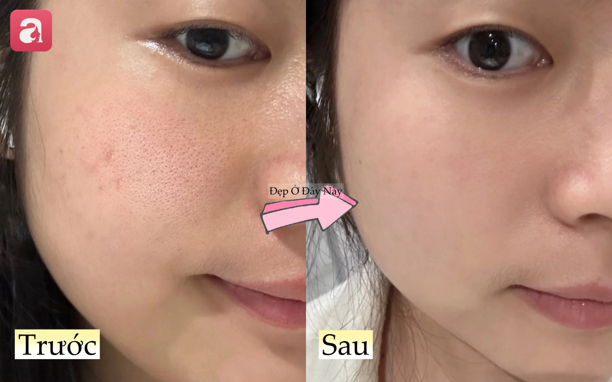 Làn da sần sùi, lỗ chân lông to của nàng blogger đã thay đổi hoàn toàn nhờ cách chăm da ít người chú ý - Ảnh 6.