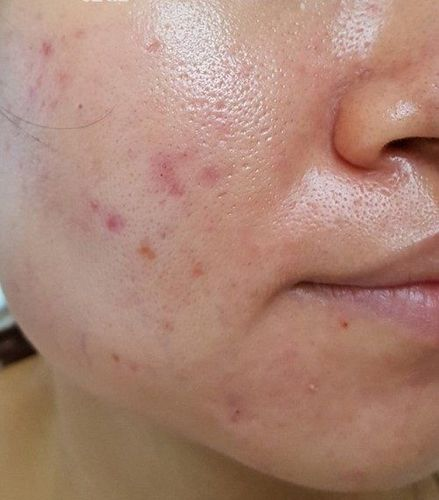 Thay vì đổi sữa rửa mặt, tôi học cách rửa mặt từ bác sĩ da liễu Hàn Quốc giúp da giảm dầu nhờn, láng mịn trong mùa hè- Ảnh 1.