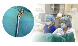 Bỏ quên vòng tránh thai suốt 30 năm, người phụ nữ 63 tuổi gặp biến chứng phụ khoa  