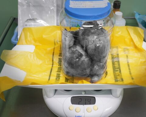 Ca mổ lấy thai đặc biệt: Đón bé 3,3kg chào đời và bóc tách thành công 9 khối u xơ tử cung