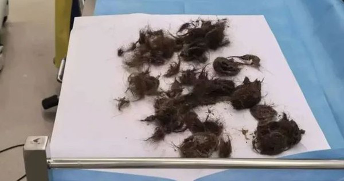 Thiếu nữ 19 tuổi hói đầu, đau bụng, bác sĩ lấy ra thứ “đáng sợ” trong dạ dày