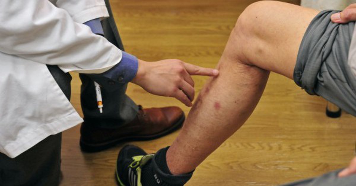 Các bác sĩ nói thẳng: Bắp chân là “đèn báo” đột quỵ, thấy 5 thứ phải đến bệnh viện ngay!