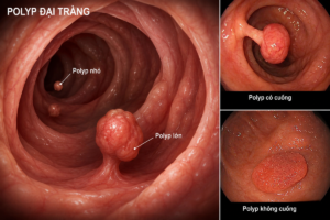 3 thực phẩm quen thuộc, dễ tìm có thể ngăn ngừa polyp đại tràng, nhiều gia đình Việt có sẵn trong bếp