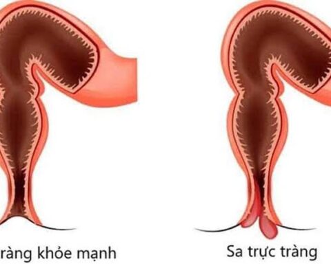 Sa trực tràng ở trẻ em có nguy hiểm?