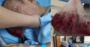 Người đàn ông nôn ra hơn 2 lít máu trong 5 phút, bác sĩ cảnh báo: 4 thói quen ăn uống “phá nát” dạ dày