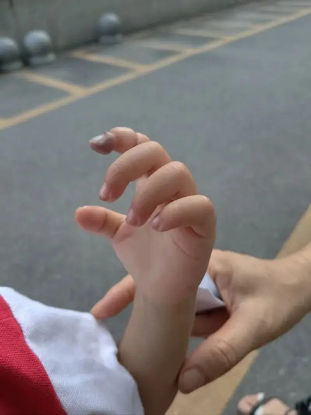 Tỉnh dậy sau giấc ngủ trưa, bé gái 2 tuổi khóc thét, cô giáo nhìn thấy tưởng không sao, cha mẹ lập tức đưa đi viện- Ảnh 2.