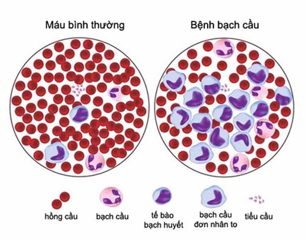 Nam công nhân bị bạch cầu cấp tính, suýt mất mạng vì xem nhẹ kiểu 