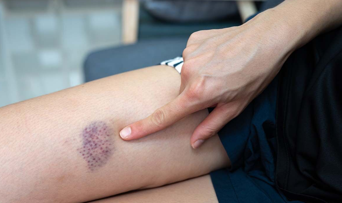 Nam công nhân bị bạch cầu cấp tính, suýt mất mạng vì xem nhẹ kiểu 