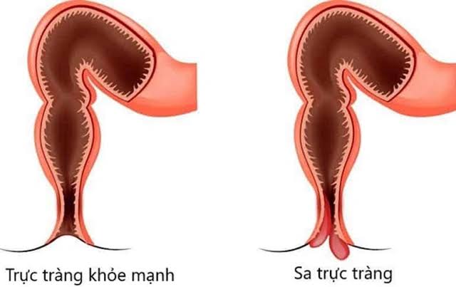 Sa trực tràng ở trẻ em có nguy hiểm? - Ảnh 1.