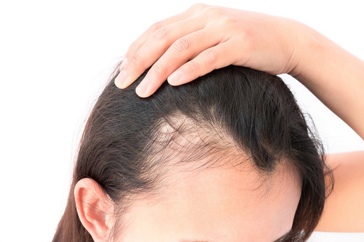 Gội đầu kiểu này cực hại da đầu lại dễ gây hói: Đáng tiếc nhiều người Việt vẫn mắc, thay đổi ngay hôm nay để cứu lấy mái tóc- Ảnh 2.