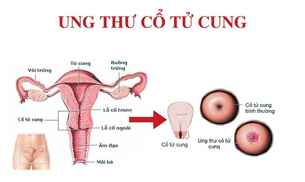 Tầm soát ung thư cổ tử cung tại y tế cơ sở: Lợi ích và hiệu quả năm 2023 - Ảnh 2.