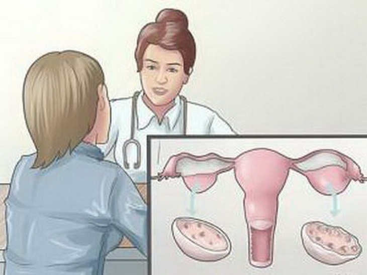Cách phân biệt u nang buồng trứng lành tính và u nang bệnh lý