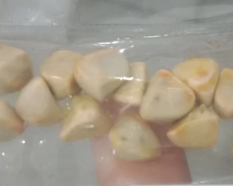 Uống trà đá đều đặn suốt 10 năm, người phụ nữ sốc khi bác sĩ lấy ra thứ “đáng sợ” trong bụng