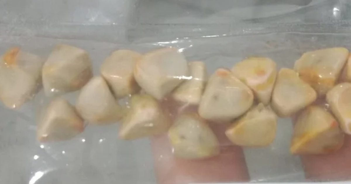 Uống trà đá đều đặn suốt 10 năm, người phụ nữ sốc khi bác sĩ lấy ra thứ “đáng sợ” trong bụng