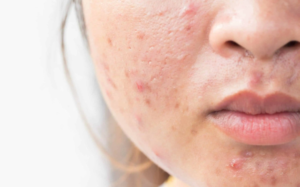 5 cách ngăn ngừa mụn trứng cá trong kỳ kinh nguyệt