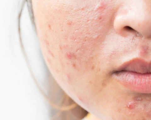 5 cách ngăn ngừa mụn trứng cá trong kỳ kinh nguyệt