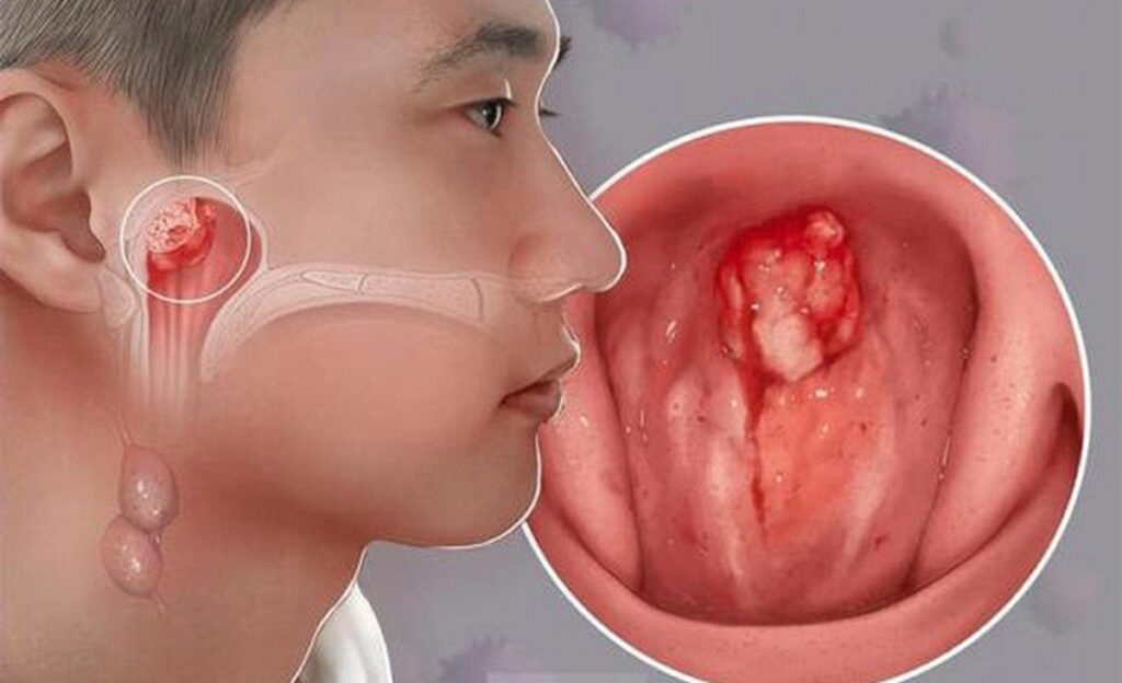 Dấu hiệu ung thư vòm mũi họng ở trẻ em và câu chuyện cảm động về bệnh nhi 14 tuổi