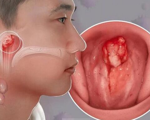 Dấu hiệu ung thư vòm mũi họng ở trẻ em và câu chuyện cảm động về bệnh nhi 14 tuổi