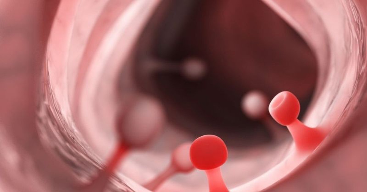 3 Người đàn ông trong gia đình mắc ung thư đại trực tràng và hội chứng Lynch nguy hiểm