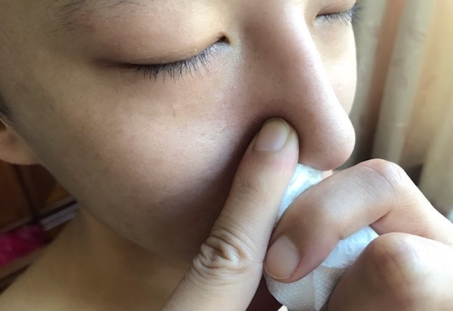 Ung thư vòm họng rất "xảo quyệt": 4 tín hiệu cầu cứu sớm nhưng dễ bị nhầm thành ốm vặt - Ảnh 2.