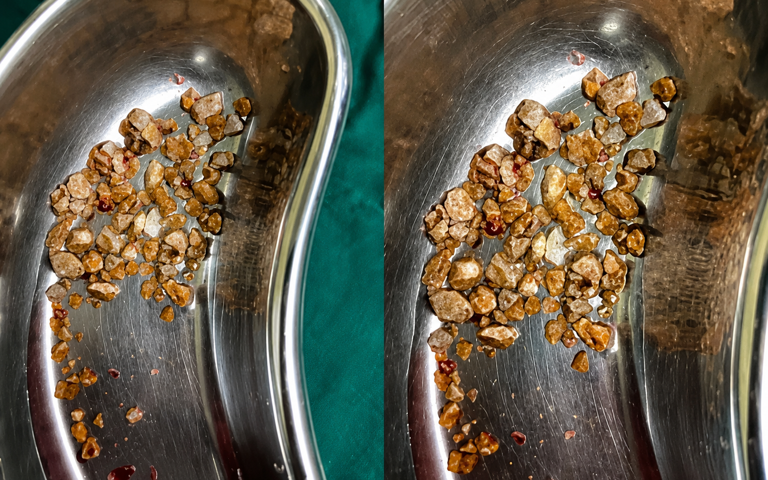 Nữ y tá 25 tuổi tiết lộ cách giảm gần 3kg chỉ trong 5 phút không cần bất cứ dụng cụ gì, vợ Justin Bieber cũng rất "chuộng" - Ảnh 2.