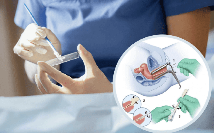 Các xét nghiệm giúp phát hiện sớm ung thư cổ tử cung