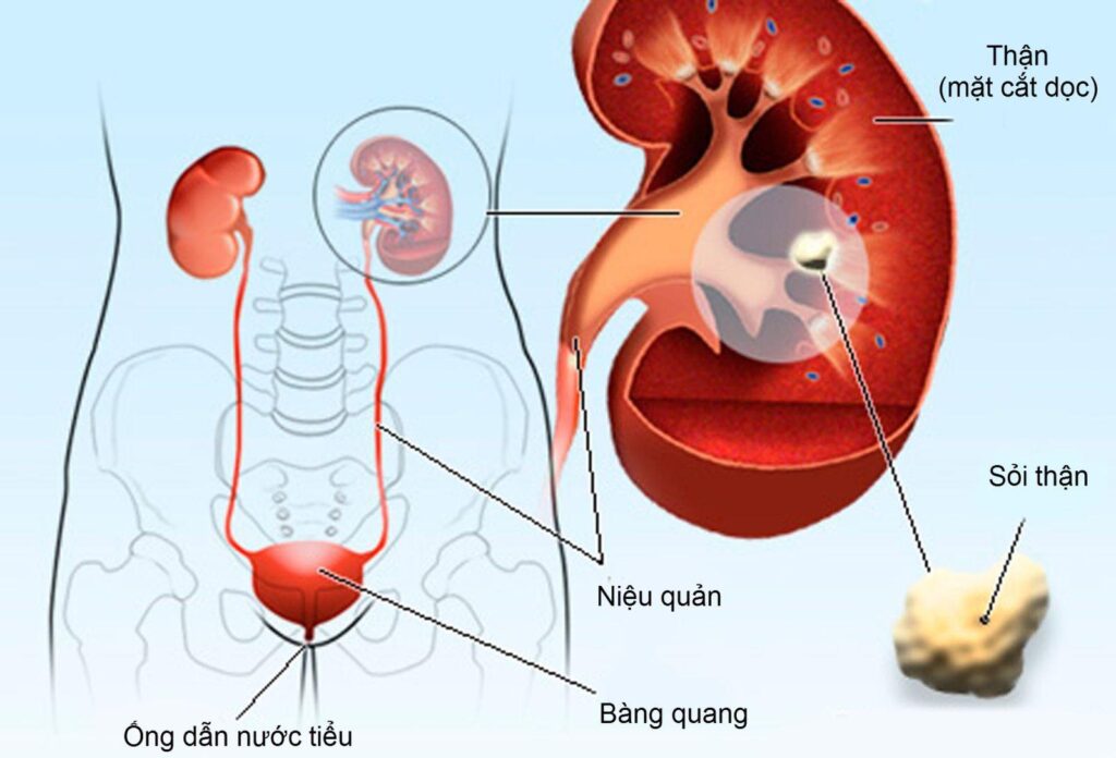 Sỏi tiết niệu ở trẻ: Phát hiện muộn có thể ảnh hưởng chức năng thận